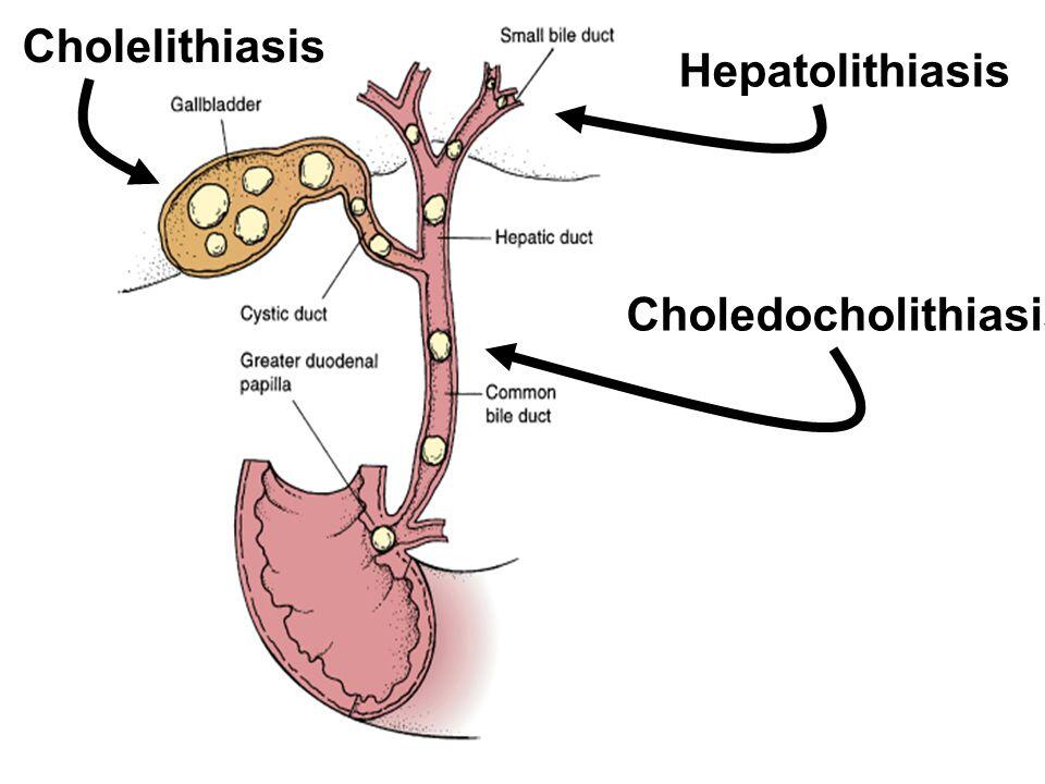 choledocholithiasis