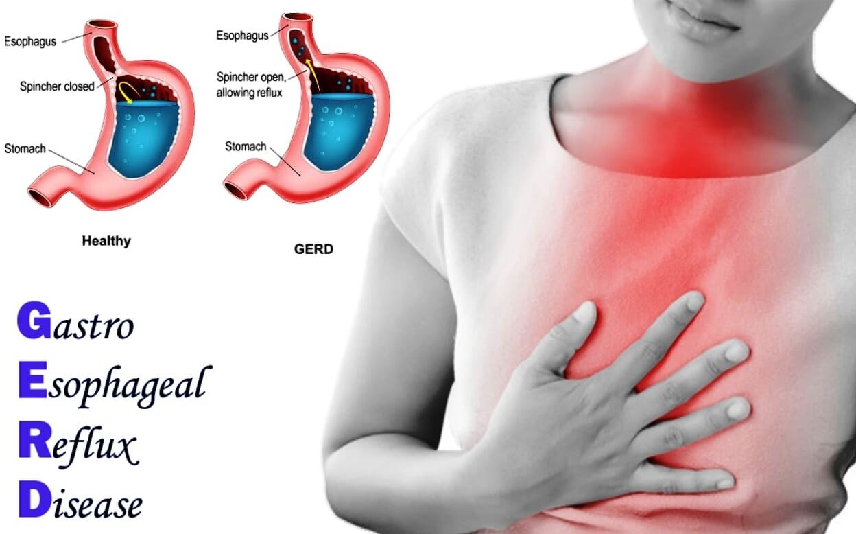 gastroesophageal-reflux-disease-encore-research-group