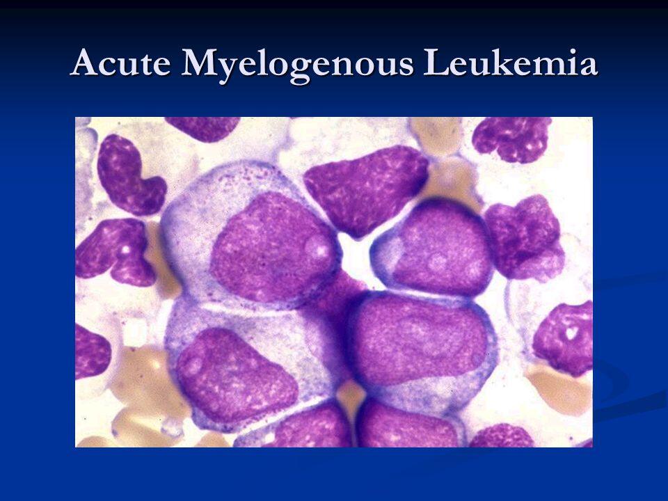 free clinical trials for acute myeloid leukemia