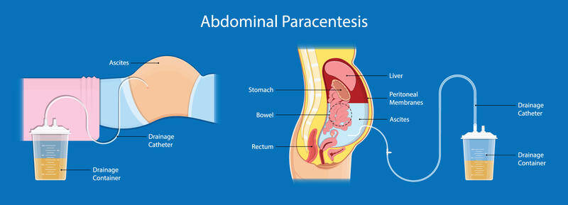 Paracentesis Anatomy