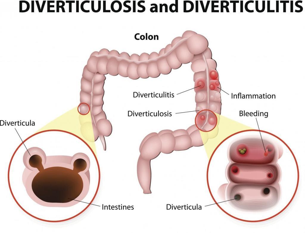 treatment-acute-diverticulitis-diseases-of-the-colon-and-rectum