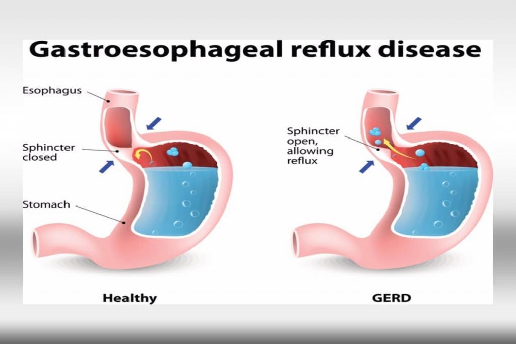 treatment-of-gastroesophageal-reflux-disease-gerd-pocketdrugguide