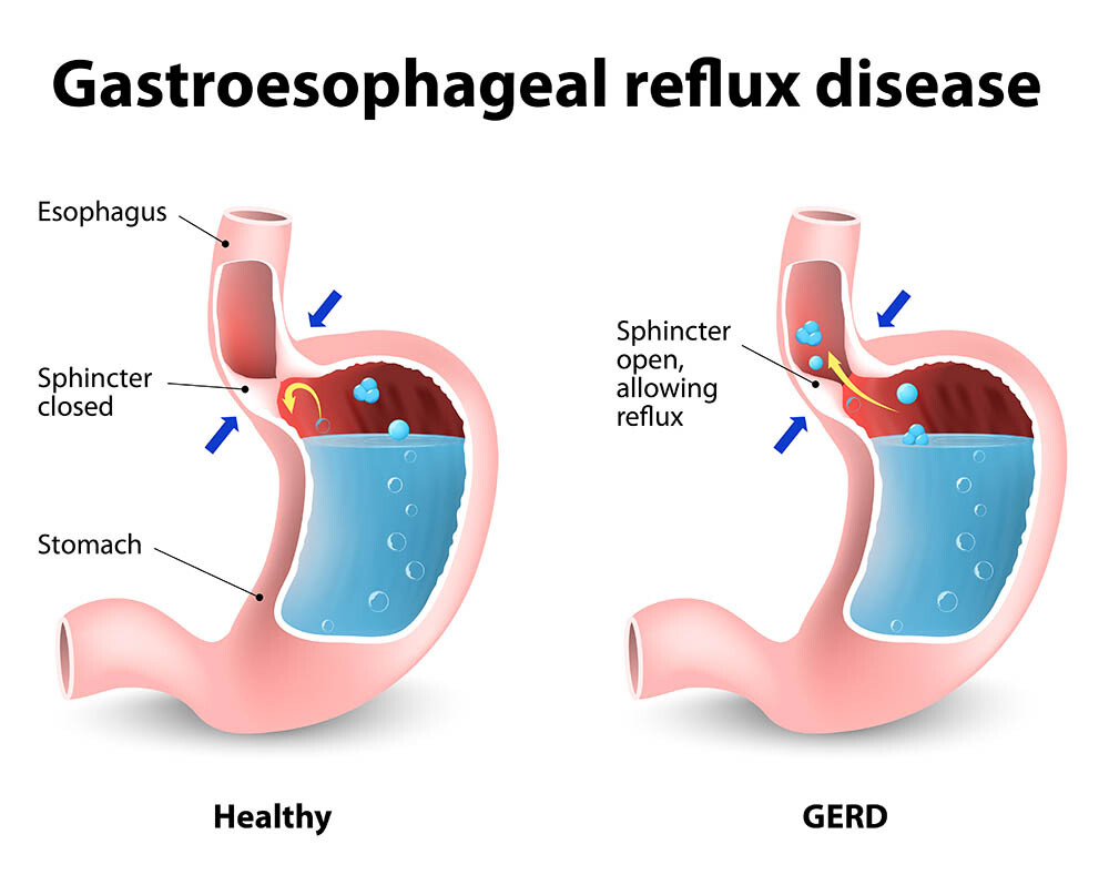 Complications of Gastroesophageal Disease - GERD - PocketDrugGuide