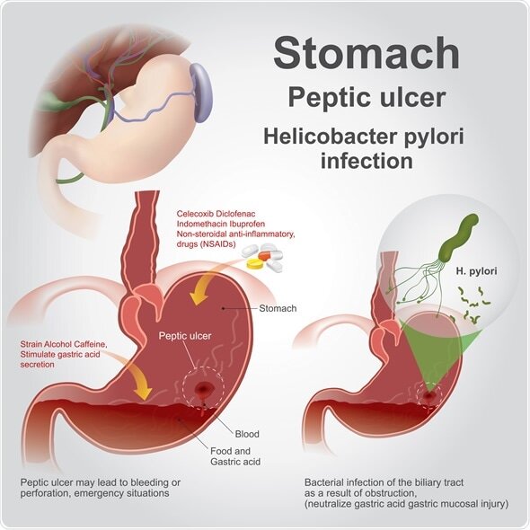 Peptic Ulcer Disease And Helicobacter Pylori Peptic Ulcer Disease Pocket Drug Guide