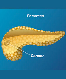 Pancreatic Cancer - Cancer - PocketDrugGuide