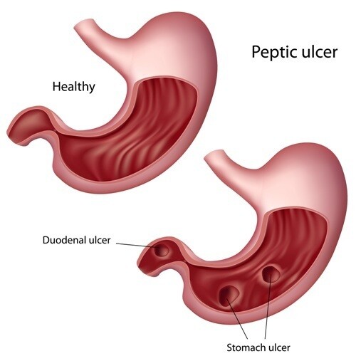 peptic-ulcer-disease-peptic-ulcer-disease-pocketdrugguide