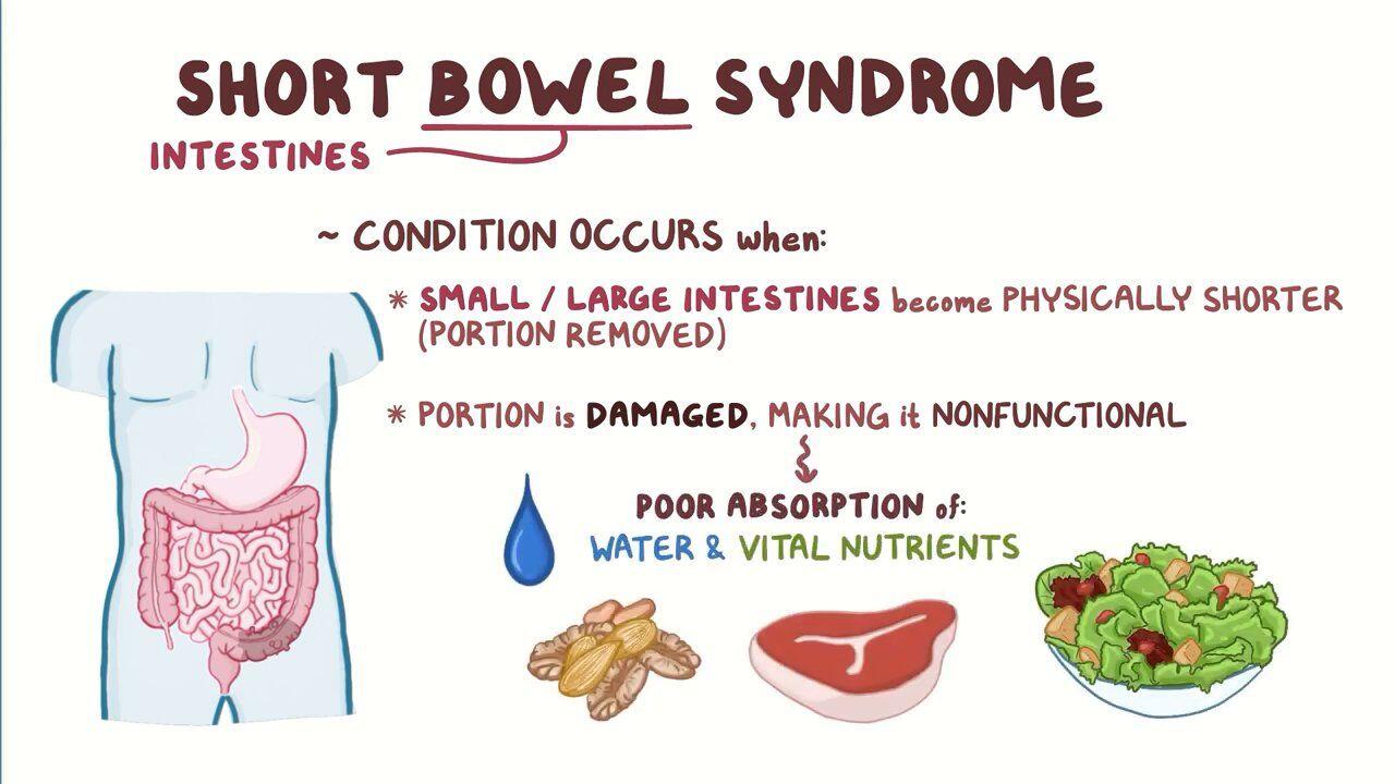 therapeutics-short-bowel-syndrome-diseases-of-the-small-intestine