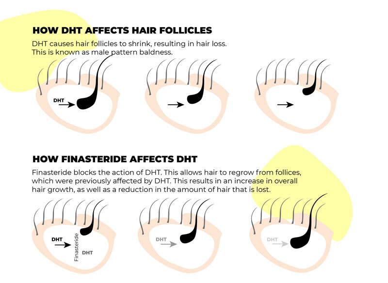 Finasteride DHT